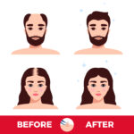 תמונות לפני ואחרי השתלת שיער שיעשו לכם חשק לשקם את שיערכם עוד השנה