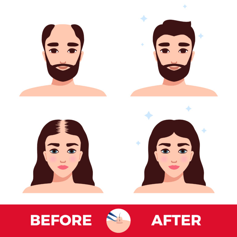 תמונות לפני ואחרי השתלת שיער